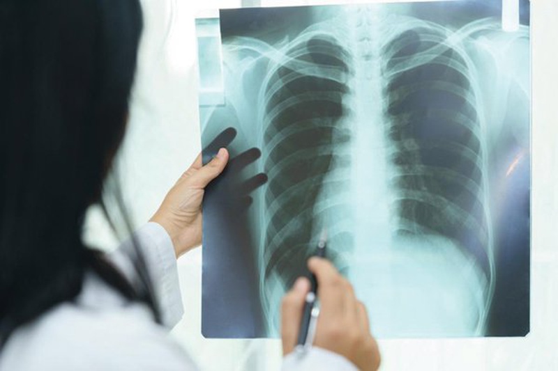 Các phương pháp điều trị tràn khí màng phổi hiện nay 1