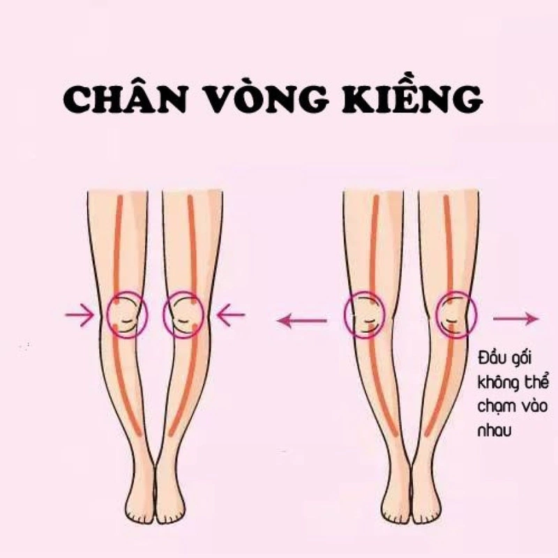 Nguyên nhân bị chân vòng kiềng