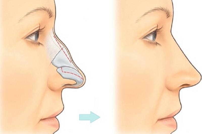 Các phương pháp nâng mũi phổ biến hiện nay 3