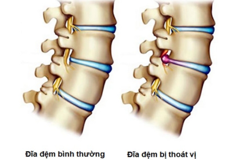 Các phương pháp phẫu thuật thoát vị đĩa đệm 1