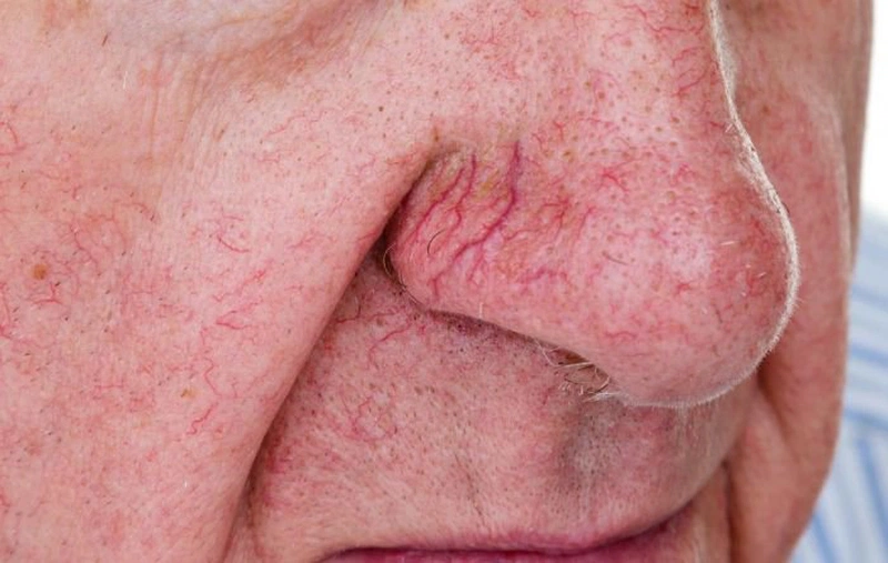Các phương pháp phục hồi da giãn mao mạch 1