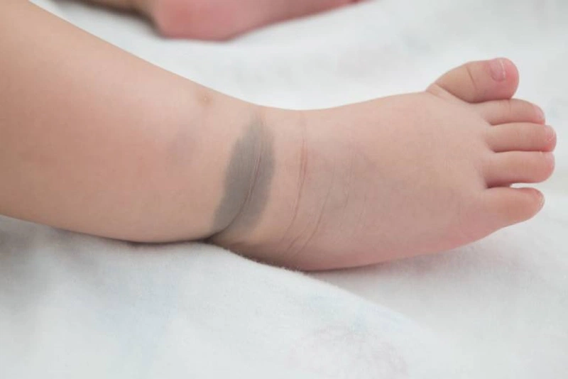 Các vết bớt ở trẻ sơ sinh thường gặp nhất và cách xử lý 4