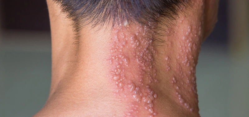 Sản phẩm sử dụng cho người bị Herpes Zoster