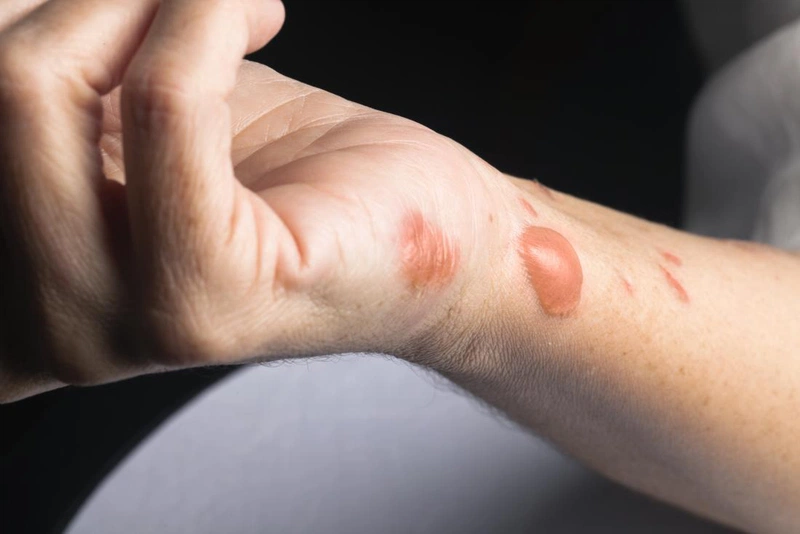 Cách chăm sóc vết bỏng bị vỡ 1