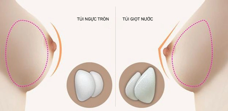 Các tiêu chí để chọn size túi ngực