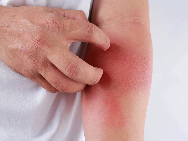 Cách chữa bệnh dị ứng hải sản không cần thuốc 1