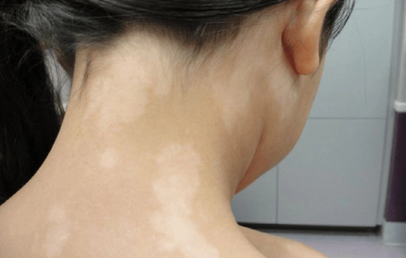 Cách chữa bệnh lang trắng ở trẻ em hiệu quả 1
