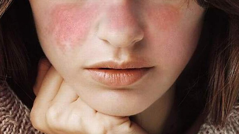 Cách trị dị ứng da mặt hiệu quả nhanh 1