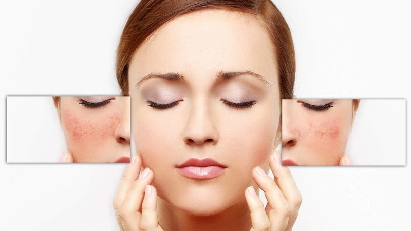 Cách trị dị ứng da mặt hiệu quả nhanh 2