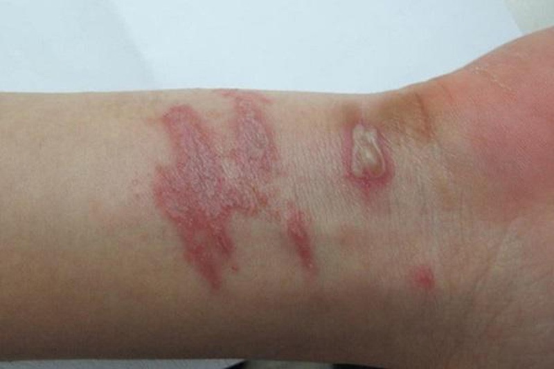 Cách chữa kiến ba khoang đốt hữu hiệu