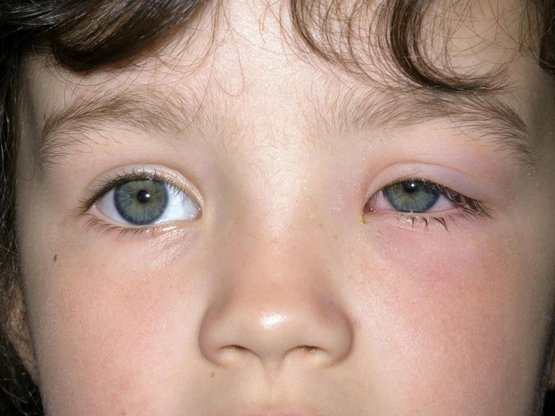 Cách chữa lẹo mắt ở trẻ em nhanh chóng, hiệu quả 1