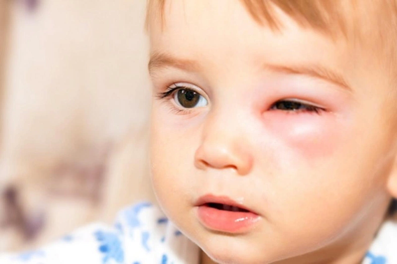 Cách chữa lẹo mắt ở trẻ em nhanh chóng, hiệu quả 3