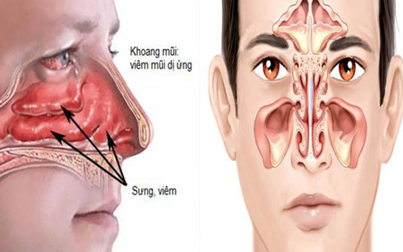 Người bị viêm xoang có thể sẽ ngủ ngáy