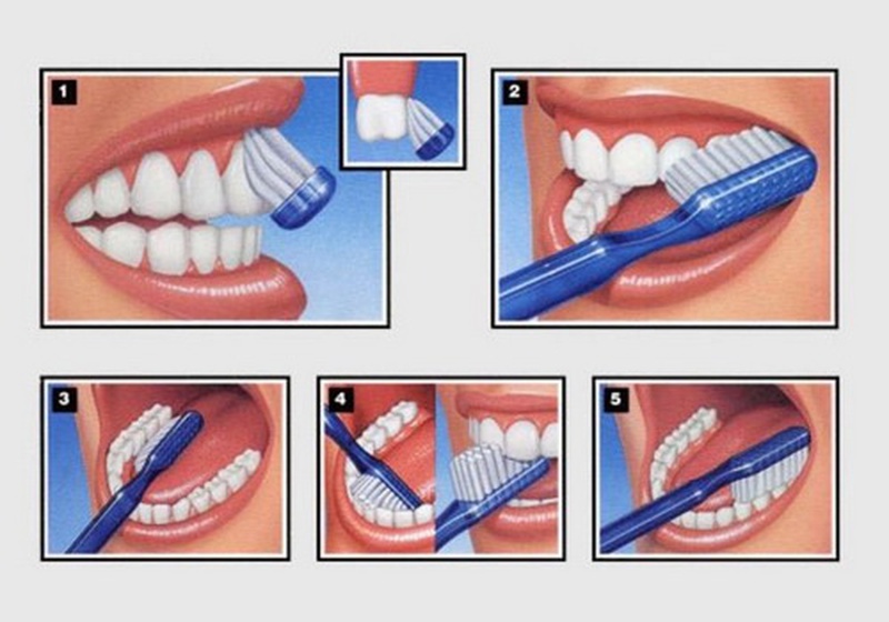 Nguyên nhân và cách điều trị bệnh viêm lợi