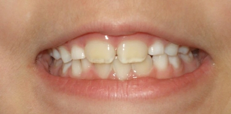 Cách chữa răng ố vàng cho bé theo từng độ tuổi hiệu quả nhất