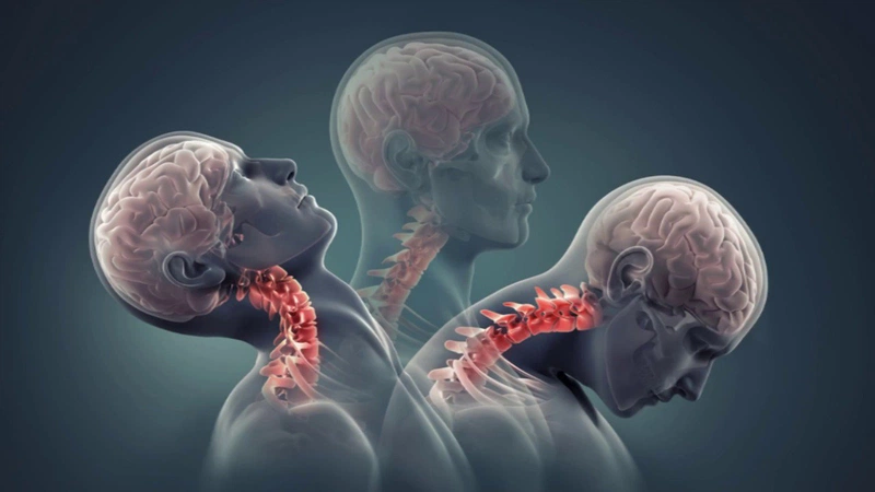 Cách chữa thoát vị đĩa đệm đốt sống cổ? Những điều bạn cần chú ý khi điều trị 3