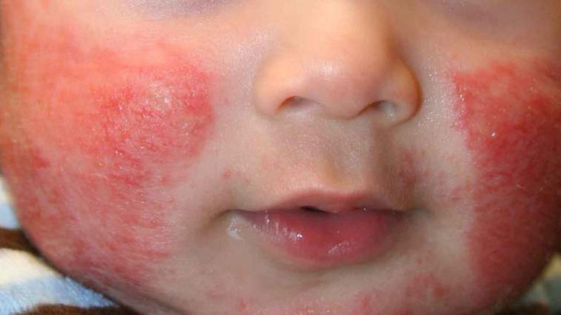 Cách chữa trị bệnh chàm Eczema ở trẻ 1