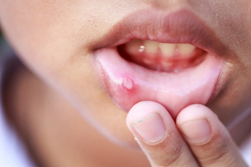 Cách chữa viêm loét miệng hiệu quả 1