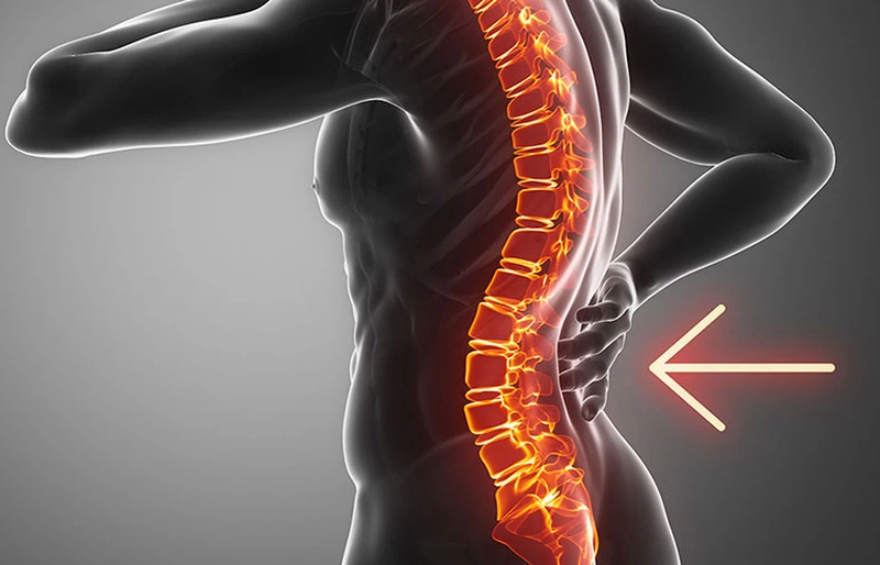 Võng lưng là một vấn đề khá phổ biến đối với người Việt Nam