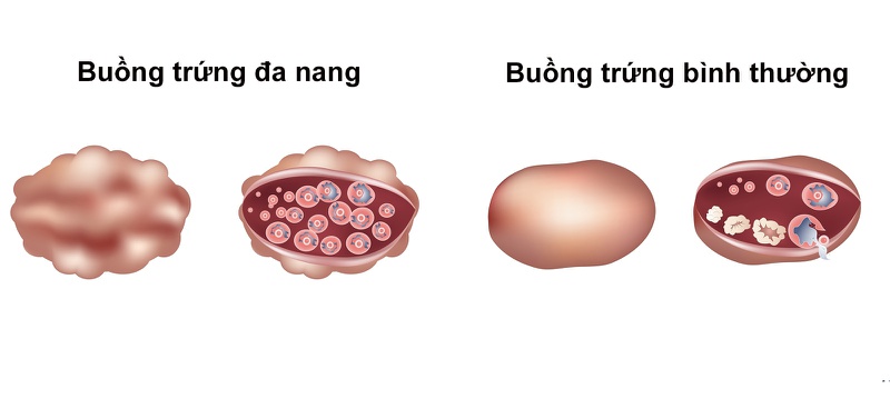 Cách dễ thụ thai cho người kinh nguyệt không đều như thế nào? 1