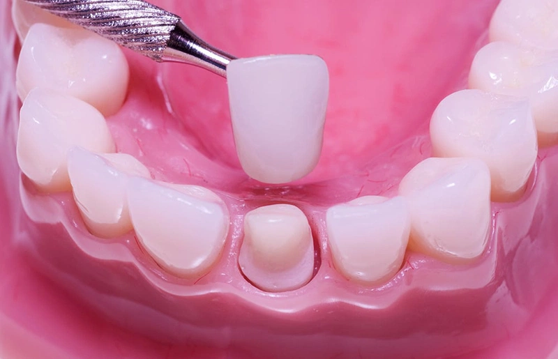 Cách điều trị răng nhiễm fluor an toàn: bọc răng sư