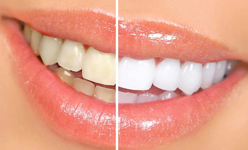 Cách điều trị răng nhiễm fluor an toàn: tẩy trắng răng