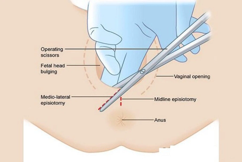 Cách điều trị sẹo lồi tầng sinh môn 2