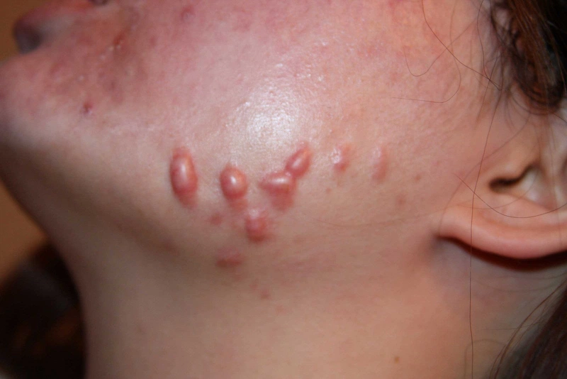 Cách điều trị sẹo lồi trên mặt hiệu quả 1