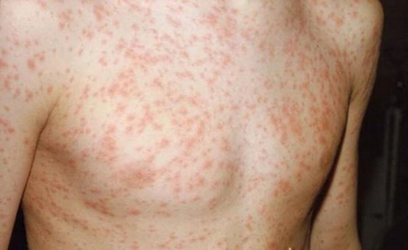 Cách điều trị sốt phát ban ở người lớn là gì?