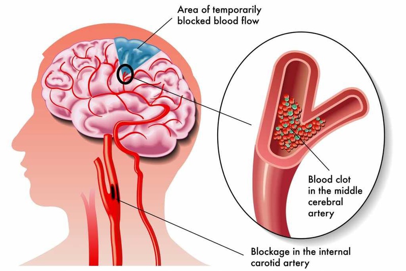 Bác sĩ Tây y nói gì về cách điều trị thiếu máu lên não 2