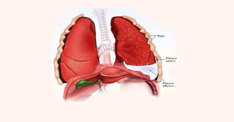 Cách điều trị tràn dịch màng phổi tại nhà 1