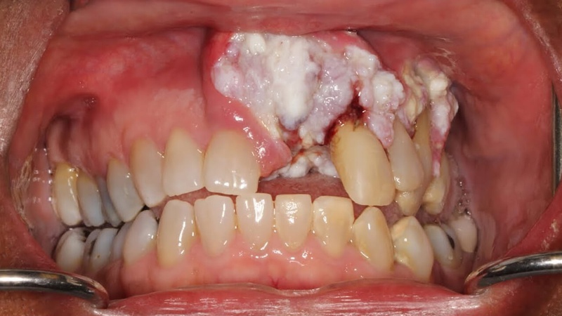 Cách điều trị ung thư nướu răng 1