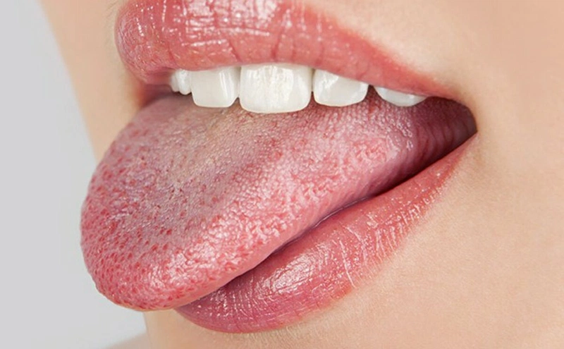 Cách điều trị và phòng ngừa nấm miệng lưỡi - Nhà thuốc FPT Long Châu