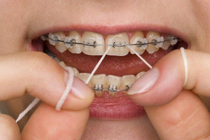 Dùng chỉ nha khoa giúp hạn chế tình trạng sâu răng