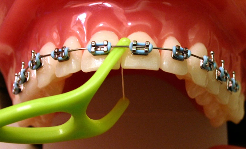 Lưu ý cách dùng chỉ nha khoa khi niềng răng