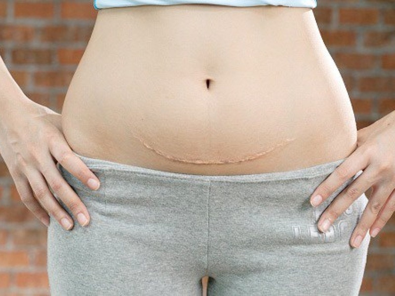 Cách giảm cân sau sinh mổ nào hiệu quả 2