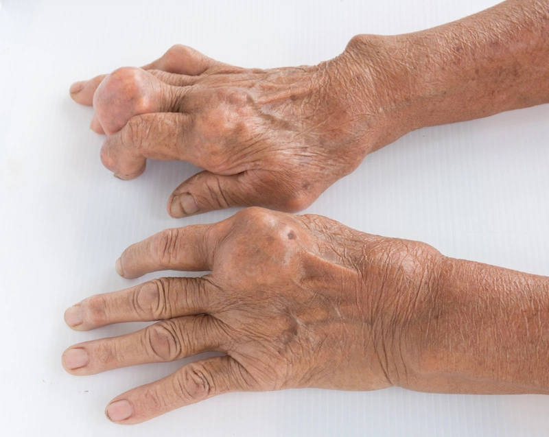 Cách giảm đau gout hiệu quả cho người bệnh 1