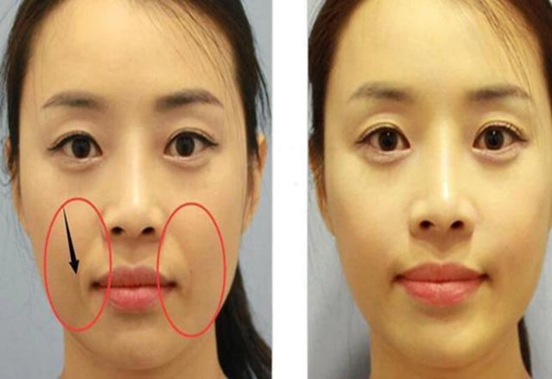 Cách làm đầy rãnh cười đơn giản tại nhà 1
