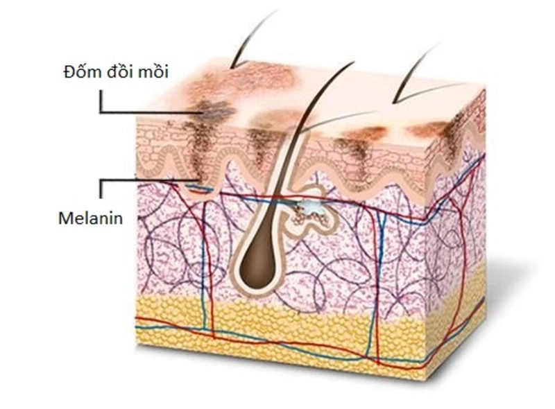 Cách làm mờ đốm đồi mồi ở mu bàn tay tại nhà 2