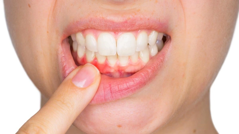 Súc miệng với dầu dừa giúp chống viêm nướu