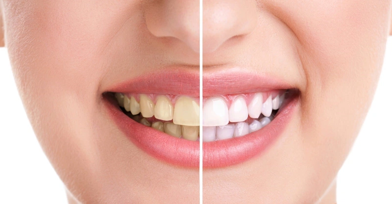 Thay vì súc miệng có thể chà xát dầu dừa lên răng để tẩy trắng răng