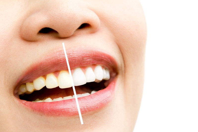 Duy trì chế độ làm trắng sáng răng bằng vỏ chuối
