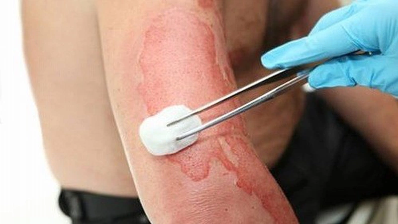 Cách làm vết bỏng nhanh khô 2
