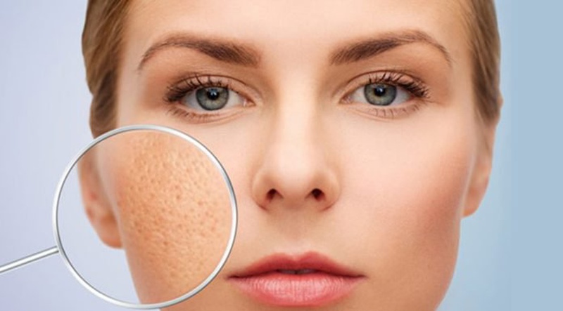 Cách làm xẹp mụn sưng đỏ không nhân 2