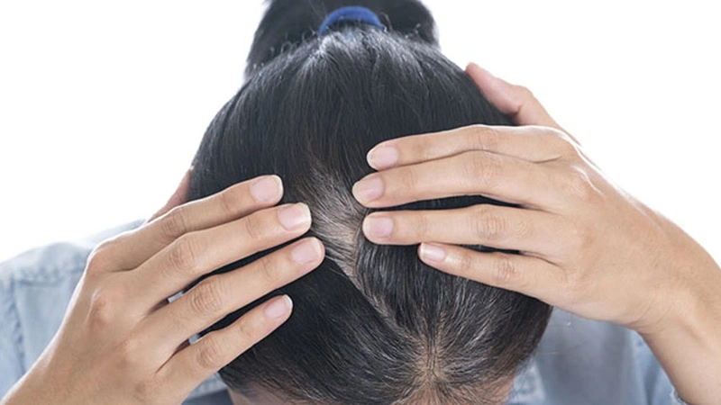 Gội đầu bằng hà thủ ô là phương pháp không những khắc phục tình trạng rụng tóc mà còn giúp ngăn ngừa tóc bạc sớm