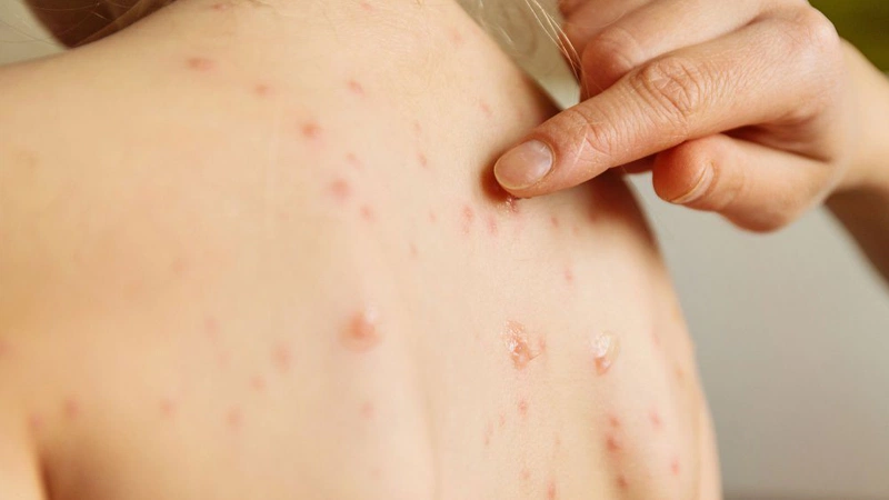 Cách nhận biết bệnh sởi trẻ em qua những dấu hiệu đơn giản