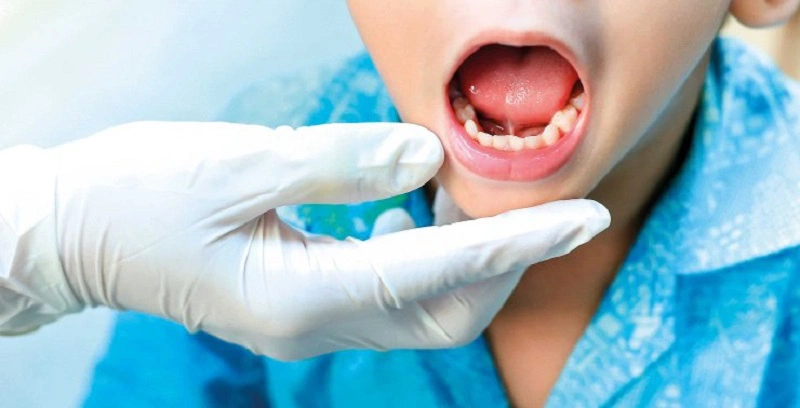 Cách nhận biết dính thắng lưỡi ở trẻ em3