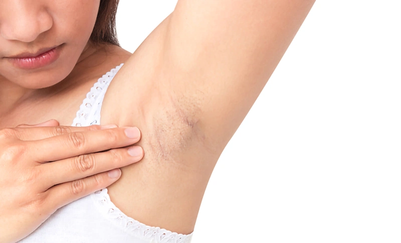 Có nên nhổ lông nách thường xuyên không? Có cách nào nhổ lông nách không gây thâm?