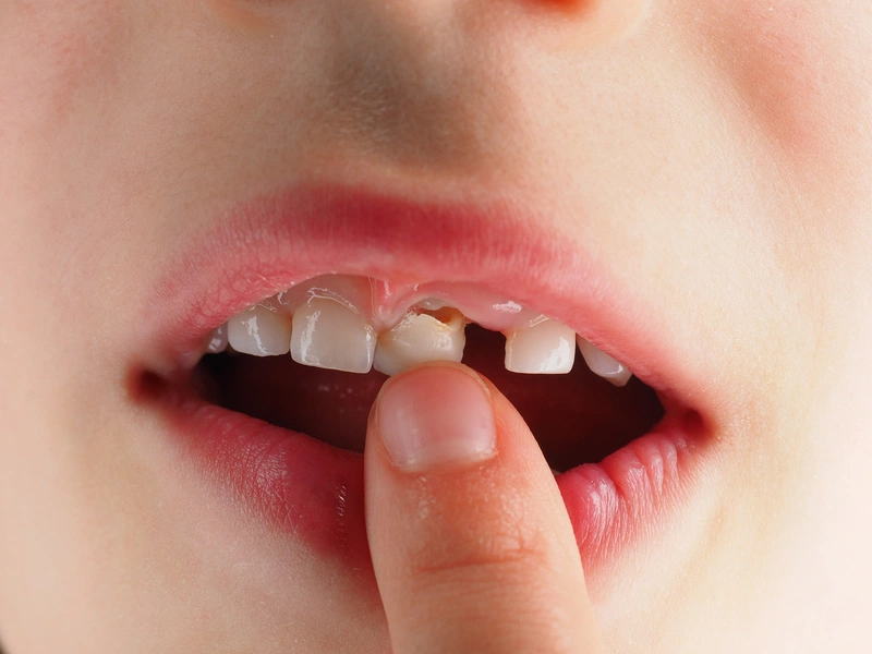 Cách nhổ răng sữa không đau cho trẻ 1