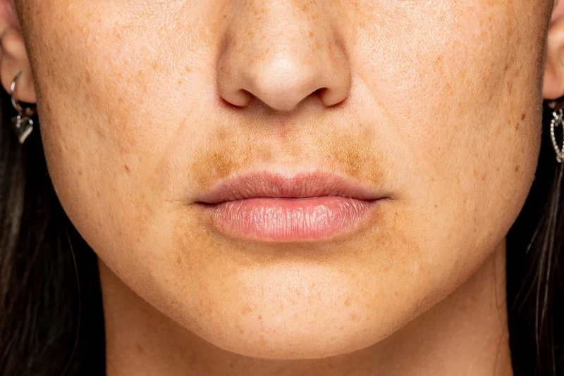 Cách skincare cho da không đều màu bạn nên biết 2